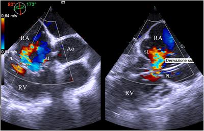Transcatheter Tricuspid Valve Therapy: From Anatomy to Intervention